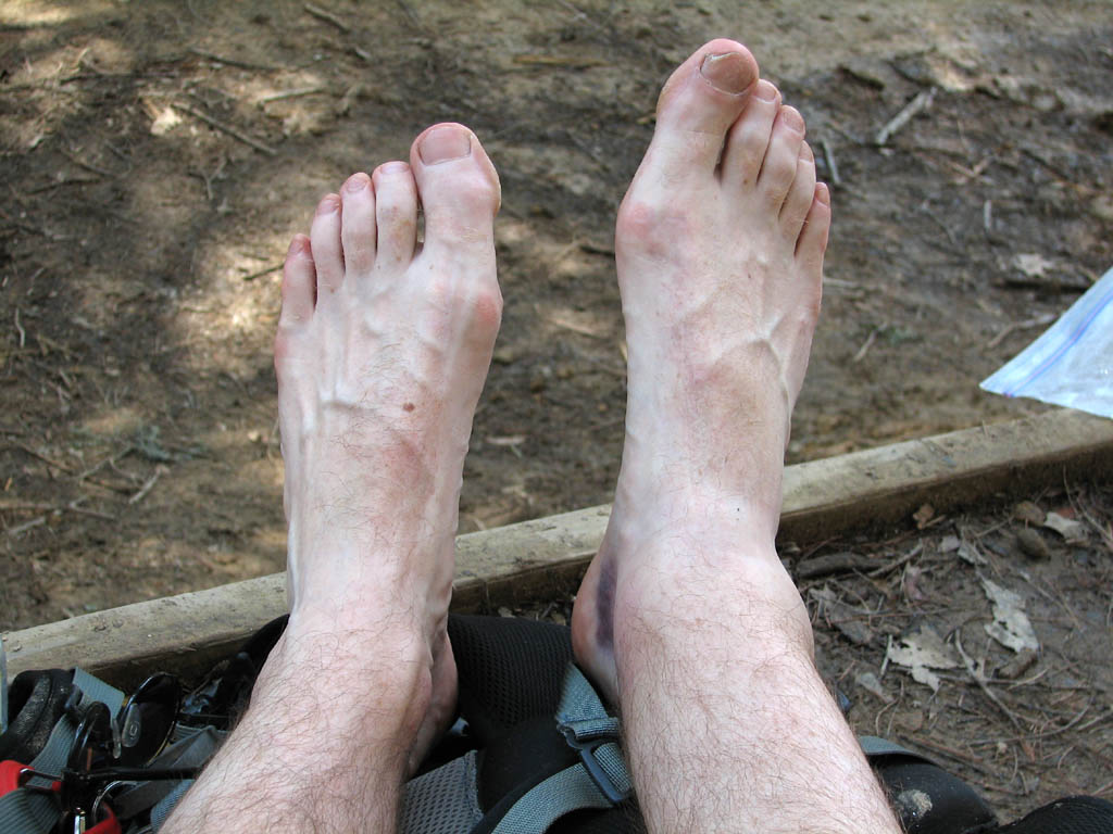 My ankle one day after being injured. (Category:  Rock Climbing)