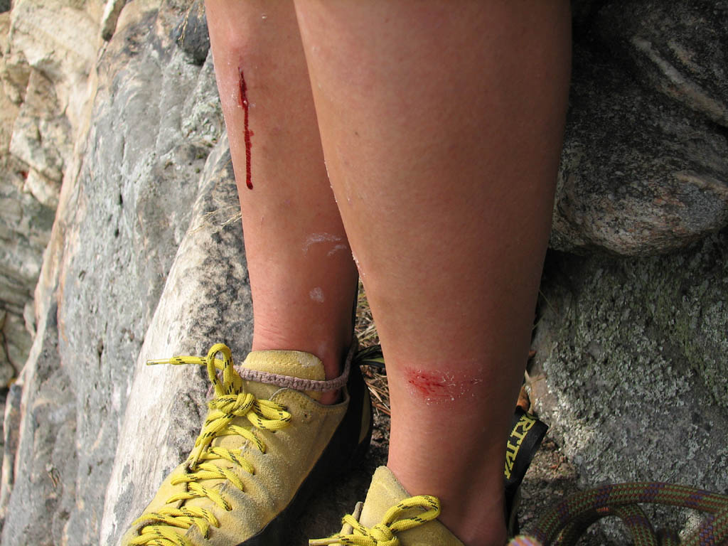 Even on toprope, a little slip can leave you bloody. (Category:  Rock Climbing)