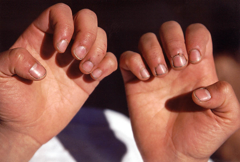 Lauren's hands after six days of climbing. (Category:  Rock Climbing)